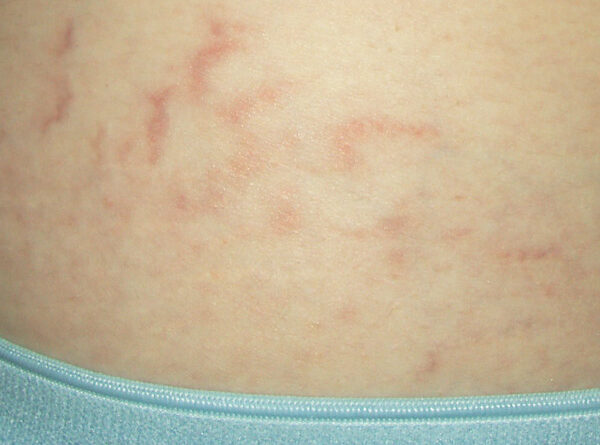 How To Get Rid Of Stretch Marks On Teenagers